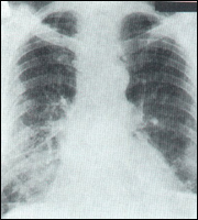Рис. 13. Рентгенограмма больного с мезотелиомой плевры справа