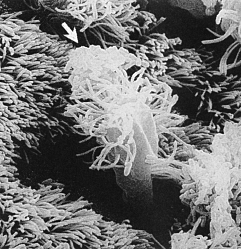 Рис. 2. Сканирующая электронограмма B. рertussis, инфицирующих клетки цилиндрического реснитчатого эпителия респираторного тракта. Скопление бактерий на частично вытолкнутой эпителиальной клет- ке (показана стрелкой)