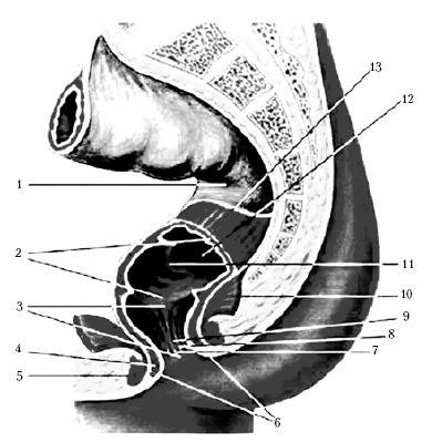 Рис. 1. Анатомия прямой кишки: 1 – серозная оболочка (брюшина) ректосигмоидного отдела толстой кишки; 2 – ампула прямой кишки; 3 – заднепроходный канал; 4 – внутренний сфинктер заднего прохода; 5 – наружный сфинктер заднего прохода; 6 – задний проход; 7 – заднепроходный гребень; 8 – заднепроходные колонны Морганьи; 9 – заднепроходная пазуха; 10 – мышца, поднимающая задний проход; 11 – поперечная складка прямой кишки; 12 – слизистая оболочка; 13 – мышечная оболочка