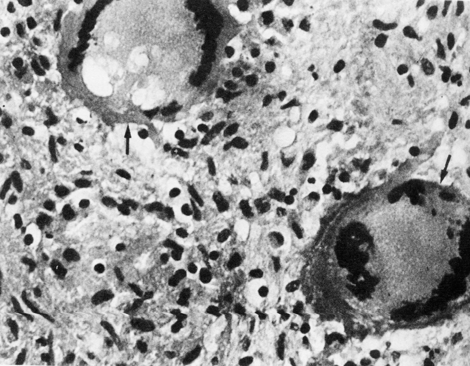 Рис. 4. Микросрез через внутреннюю часть туберкула. Видны две многоядерные гигантские клетки Лангерганса—Пирогова (стрелки) и фон из эпителиоидных клеток (трансформированные макрофаги)