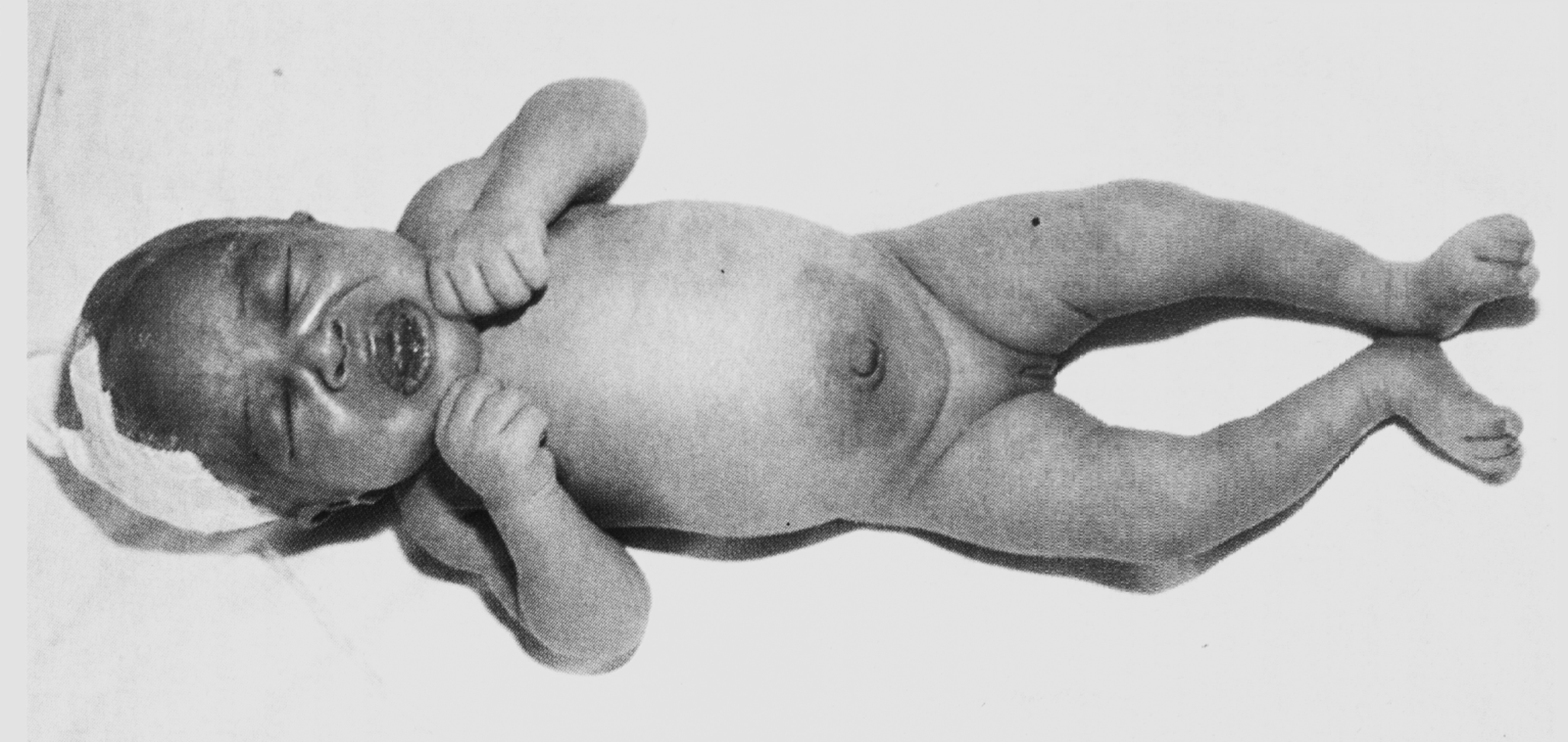 Рис. 7. Столбняк у новорожденного (tetanus neonatarum). Симп-том сардонической улыбки (risus sardonicus)