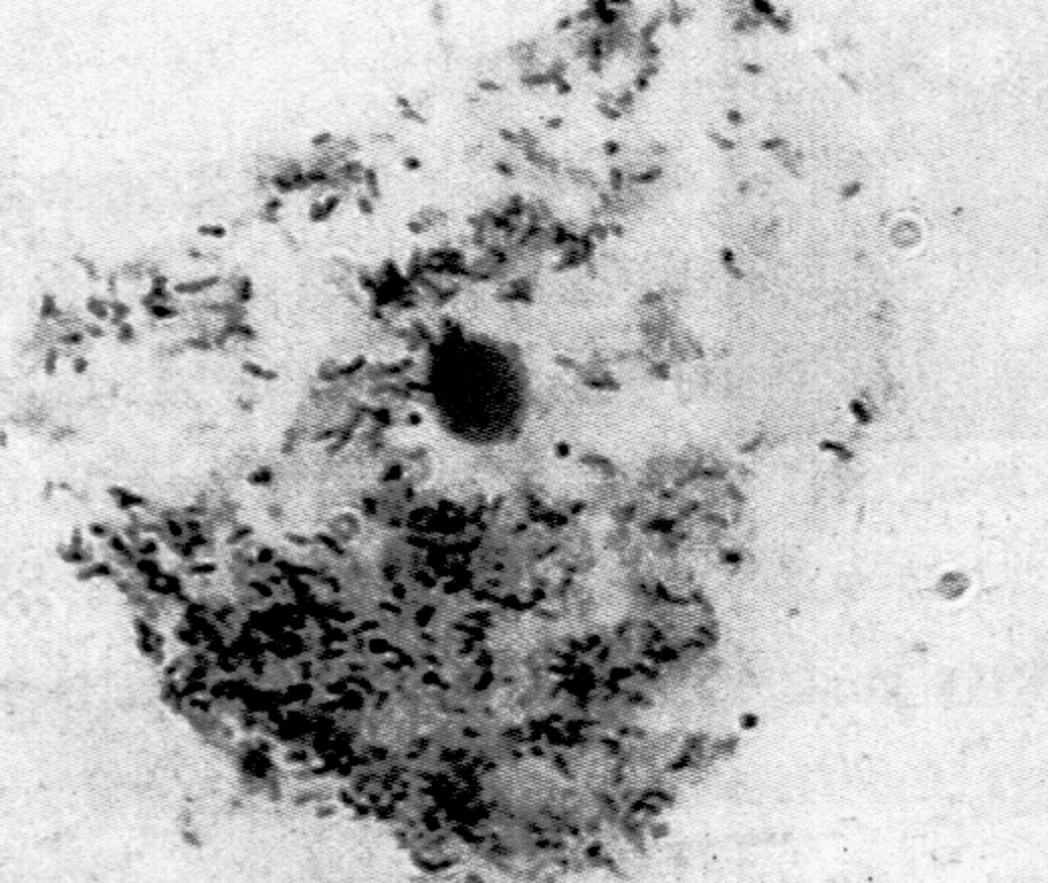 Рис. 3. Эпителиальная клетка, обсемененная бактериями при бактериальном вагинозе (clue cell). х1000