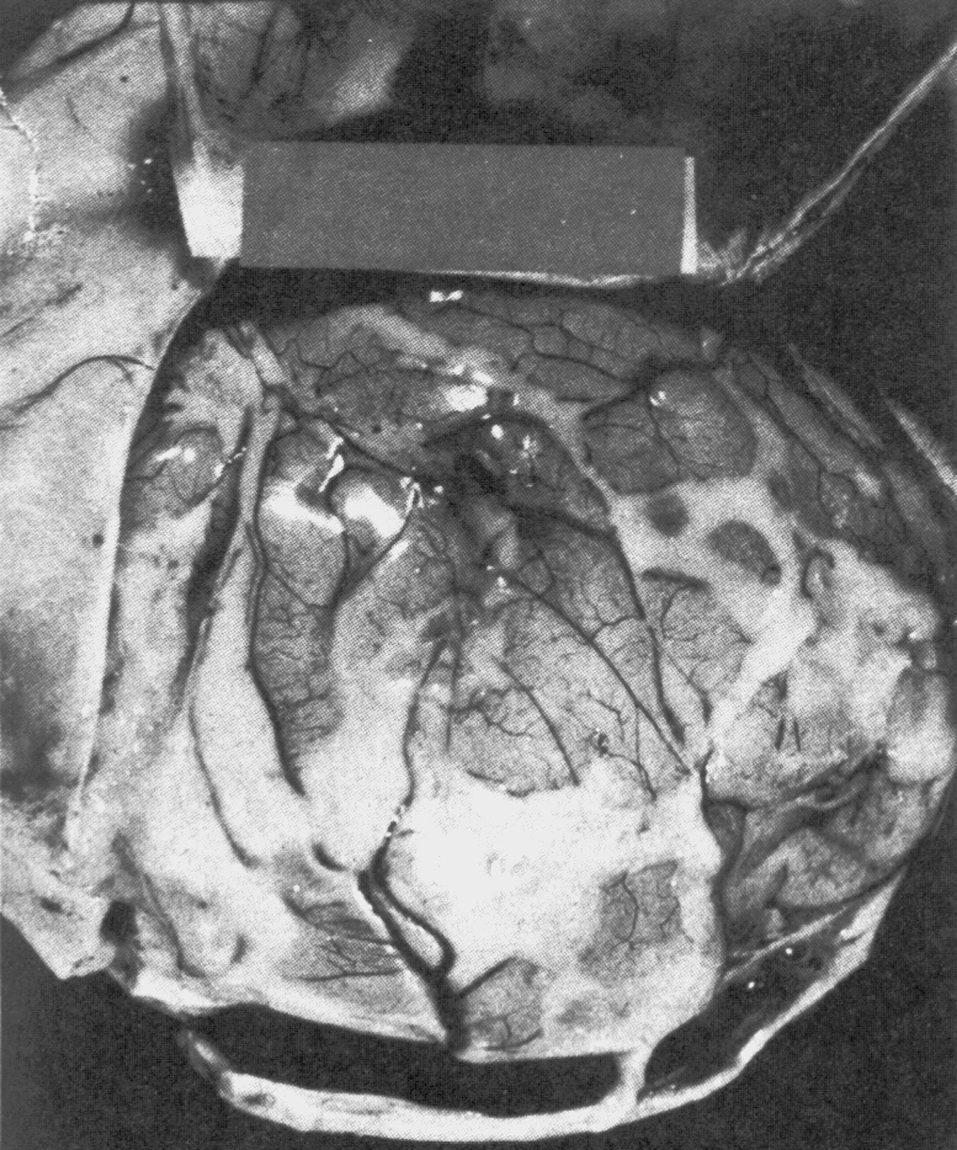 Рис. 6. Эшерихиозный менингит у 24-дневного недоношенного новорожденного. Скопления гноя и контрастированные сосуды на поверхности головного мозга (мозговые оболочки отогнуты)