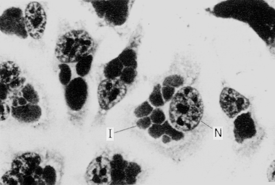 Рис. 3. Множественные внутриклеточные включения Ch. psittaci: I — включение, N — ядро клетки
