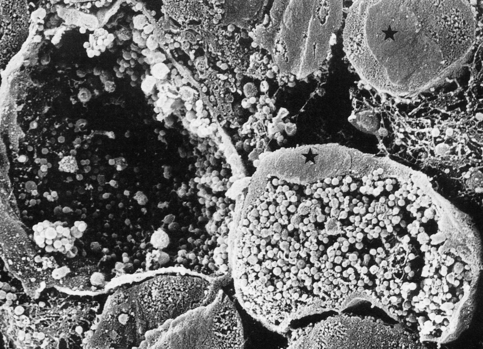 Рис. 4. Зрелые внутриклеточные включения Ch. trachomatis в культуре зараженных клеток. Справа — клетка, нафаршированная хламидийными частицами. Из клетки в левой части рисунка хламидии удалены, чтобы показать объем, занимаемый хламидийным включением. Ядра клеток обозначены звездочкой. Сканирующая электронограмма