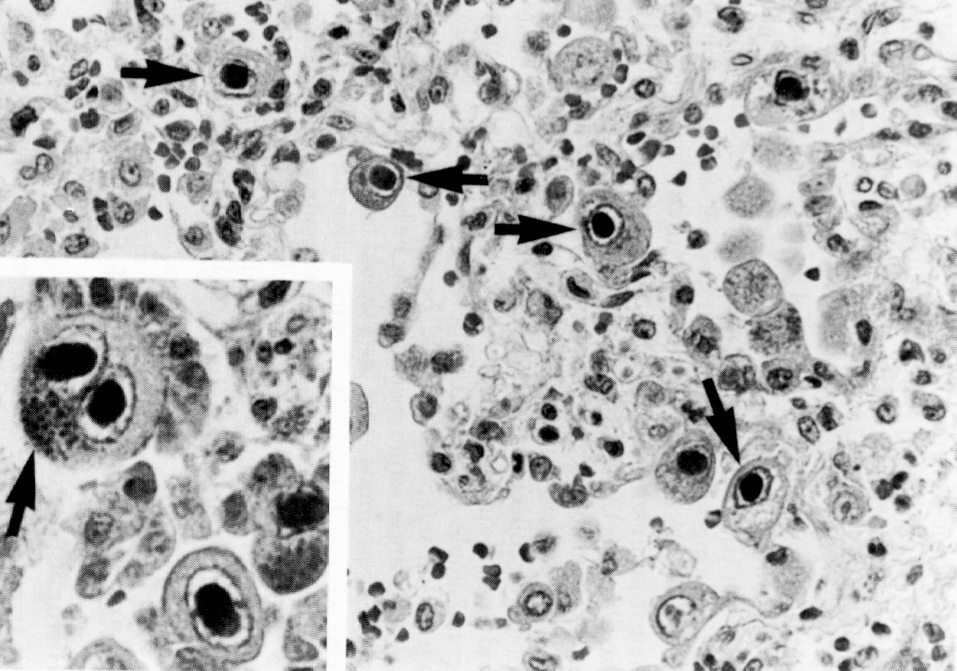 Рис. 12. Цитомегаловирусная инфекция легких (почек). Видны гигантские клетки (стрелкой отмечена увеличенная в размере ЦМВ-инфицированная клетка почечного канальца) с крупными внутриядерными включениями («совиный глаз»)