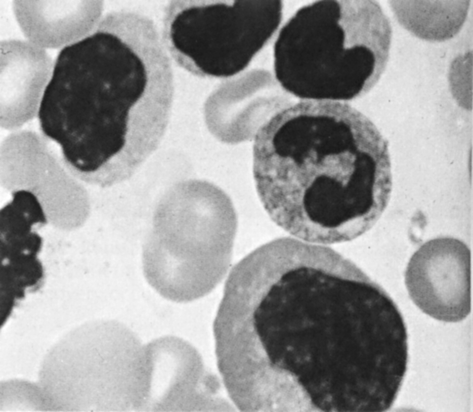 Рис. 17. Мазок крови больного инфекционным мононуклеозом. Атипичные мононуклеарные клетки (активированные Т-лимфоциты), которые различаются по размеру, форме и митотической активности
