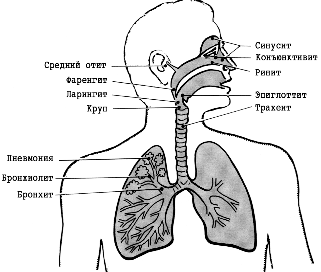 Фарингит бронхит