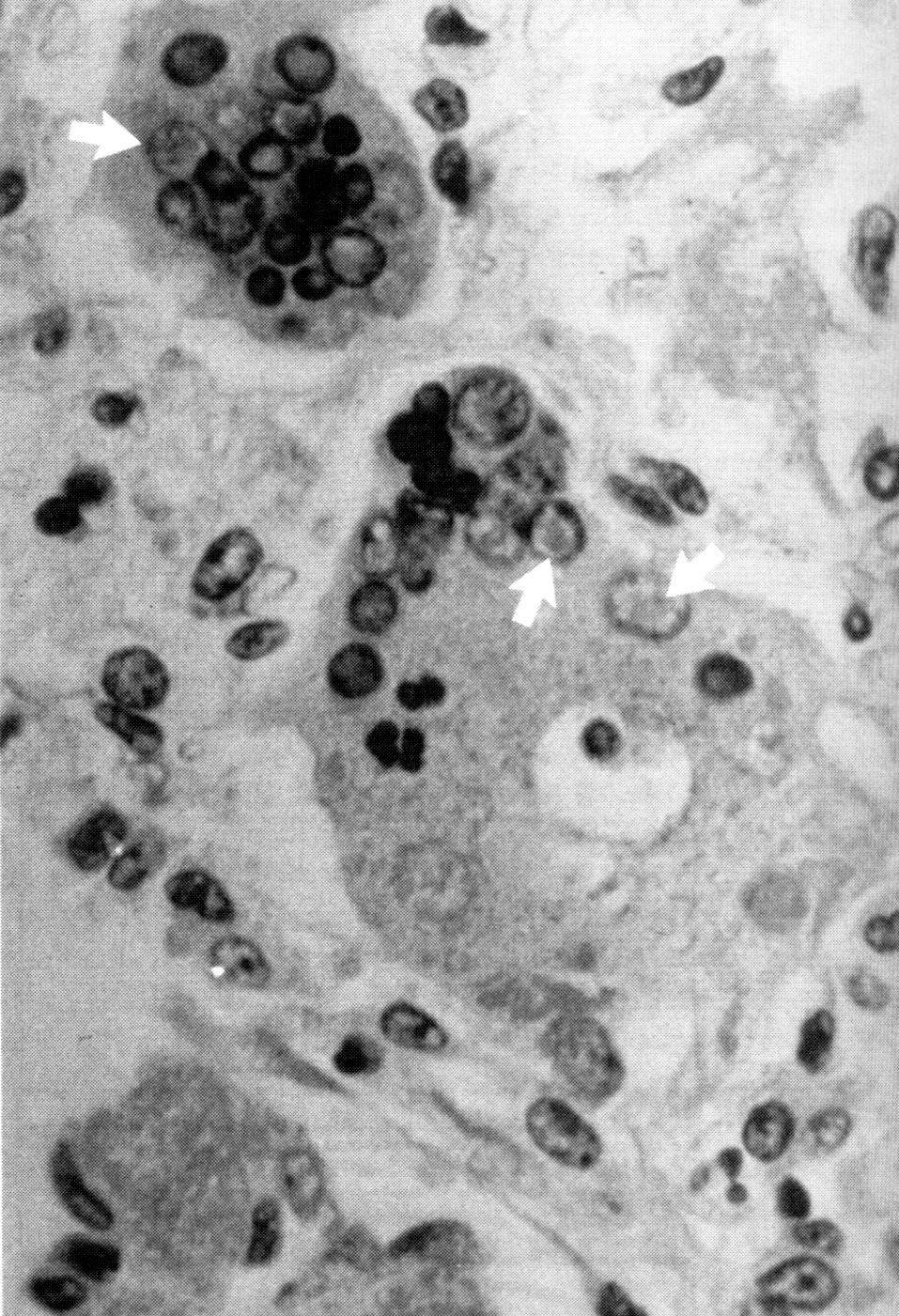Рис. 2. Гигантские многоядерные клетки при коревой гигантоклеточной пневмонии