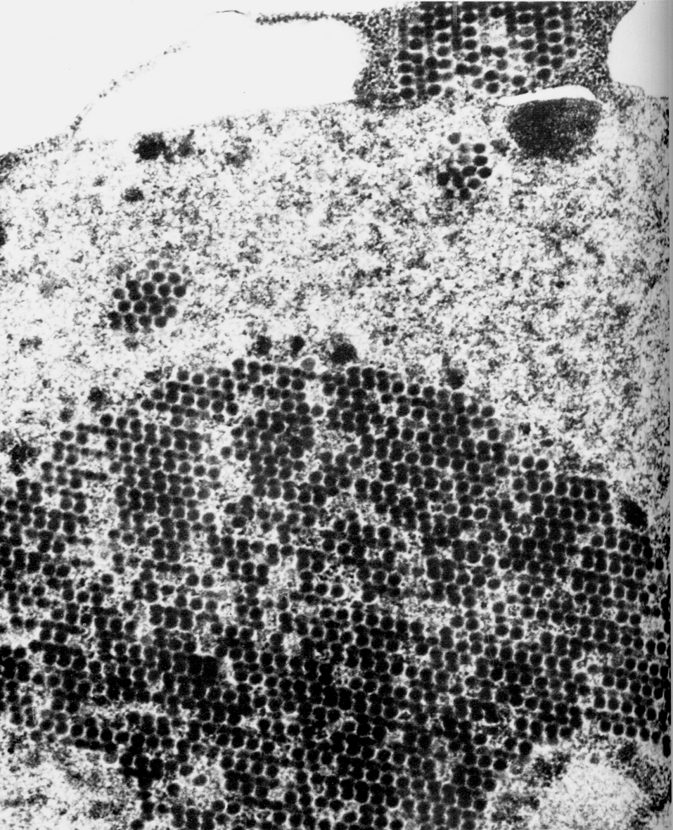 Рис. 2. Диффузное внутриядерное скопление аденовируса человека (серотип 7). В центре локализуется кристаллоподобное скопление избыточных аденовирусных белков. х 40000
