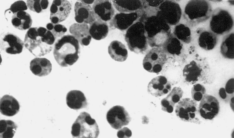 Рис. 2. Апоптоз нейтрофилов в очаге острого воспаления (зона «кожного окна»). Апоптозные клетки содержат несколько шаровидных фрагментов ядра. Апоптозные тела (результат расчленения апоптозных нейтрофилов) выглядят как мелкие мононуклеары. ґ 630 (препарат Н.А. Маянского)