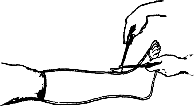 Рис. 5. Положение ножниц при снятии гипсовой повязки: (в левой руке — режущая бранша ножниц, в правой — сжимающая)