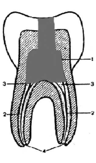 Рис. 7. Коронковый пульпит 1-коронковая пульпа; 2-корневая пульпа; 3-устья корневых каналов; 4-отверстие верхушки корня.