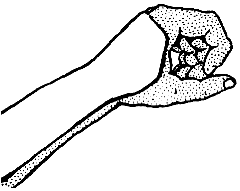 Рис. 7. Гипсовая лонгета при переломе лучевой кости в типичном месте