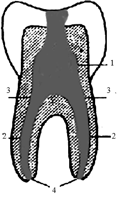 Рис.8 Корневой пульпит 1-коронковая пульпа; 2-корневая пульпа; 3-устья корневых каналов; 4-отверстие верхушки корня.