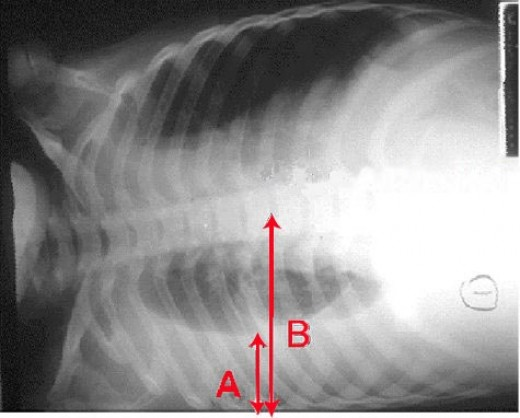 Рис. 9. Рентгенограмма больного с экссудативным плевритом, выполненная на латероскопе: А — уровень жидкости; В — правая половина грудной клетки