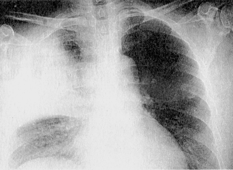 Рис. 2. Рентгенограмма больного крупозной (лобарной) пневмонией. Консолидация правой верхней доли легкого (результат заполнения альвеол воспалительным экссудатом)