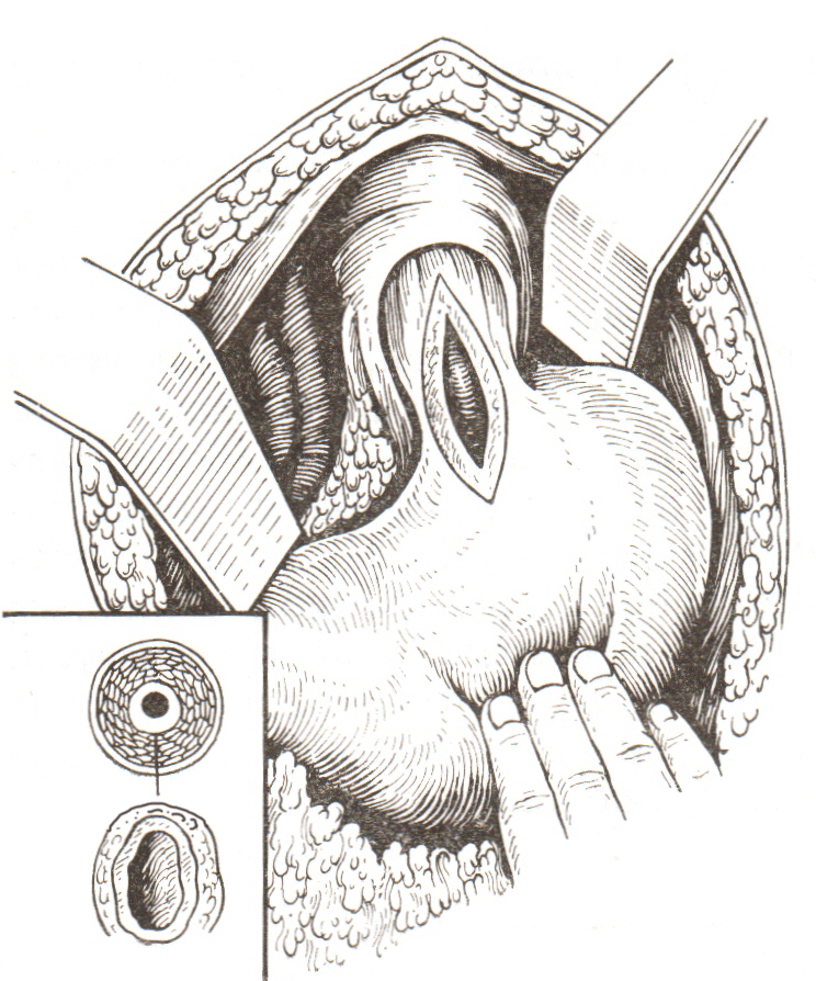 Рис. 6. Эзофагокардиомиотомия по Геллеру (Василенко В.Х., 1976)