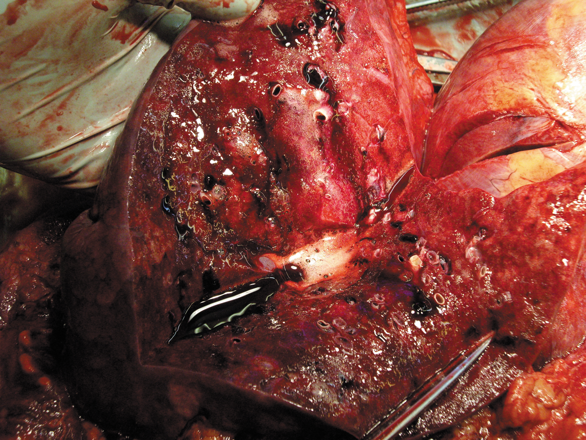Рис. 5. Патологоанатомическая картина тотальной серозно-геморрагической пневмонии и отека легких у пациента с осложненным течением гриппа А/H1N1